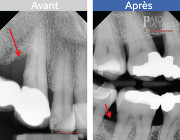 Paro Plateau Clinique de parodontie et d'implantologie du Plateau Montreal Clinique Dentaire Dentistes