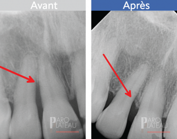 Paro Plateau Clinique de parodontie et d'implantologie du Plateau Montreal Clinique Dentaire Dentistes
