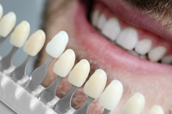 Sourire Plateau Paro Plateau Clinique de parodontie et d'implantologie du Plateau Montreal Clinique Dentaire Dentistes